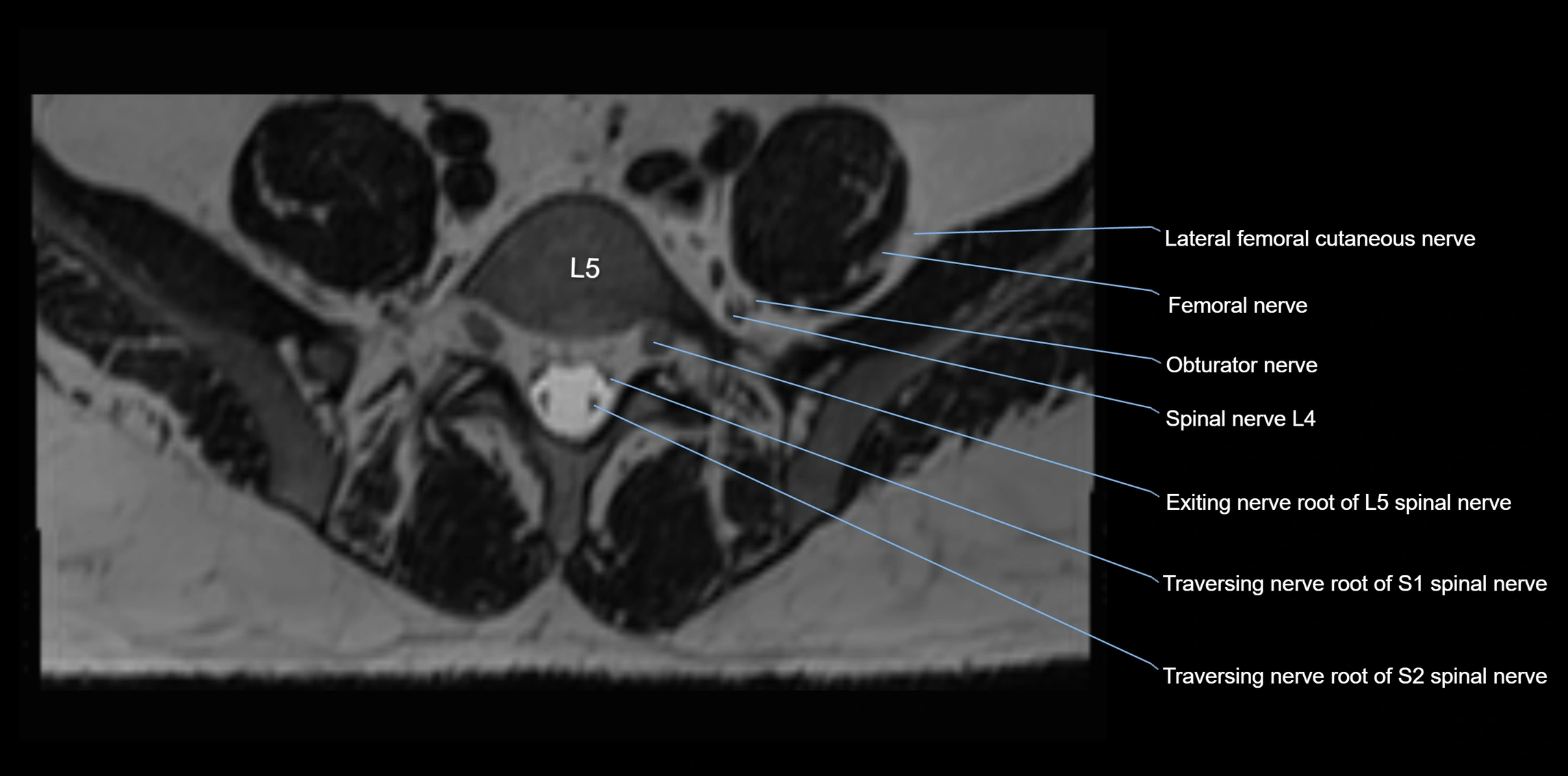 MR lumbosacral plexus axial cross sectional anatomy 3T  radiology  image-img-1008001-00058.webp